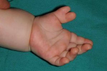  Polidaktili