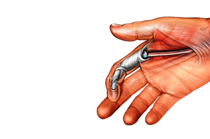 Fleksor tendon yaralanmaları