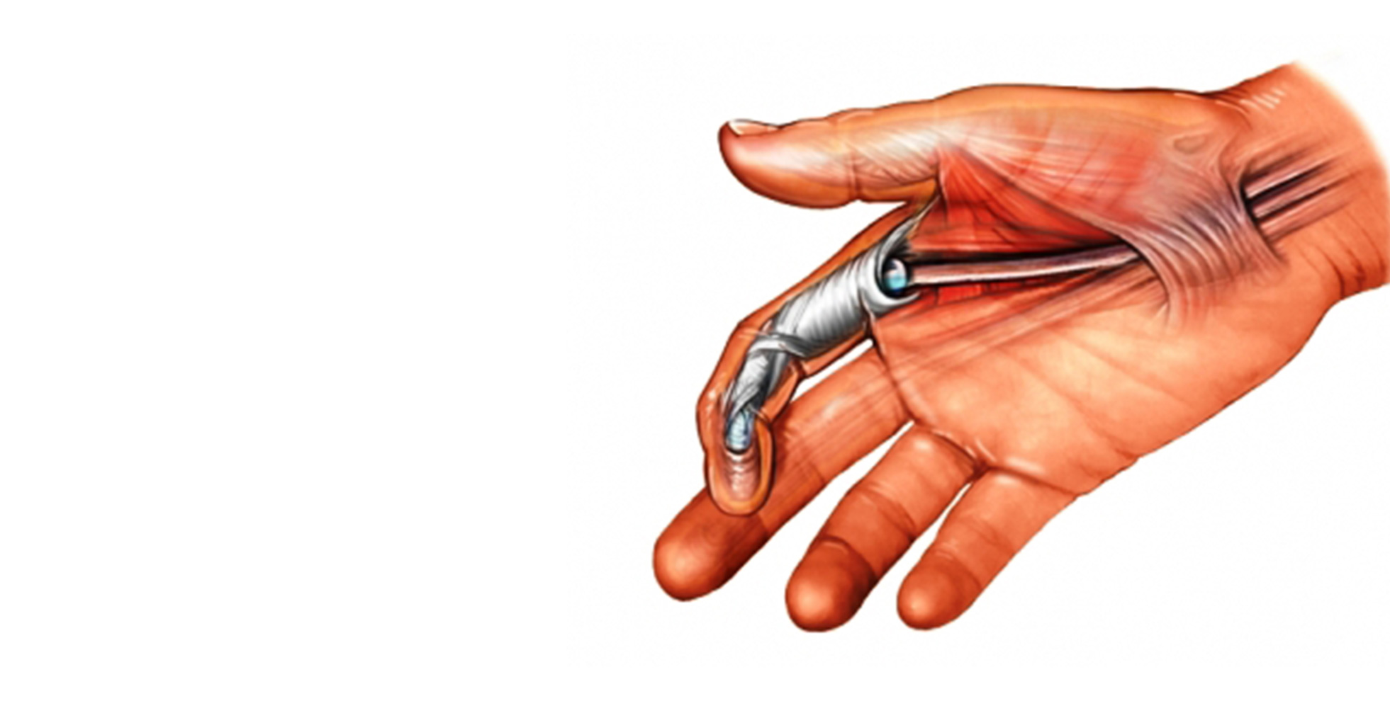 Fleksor tendon yaralanmaları