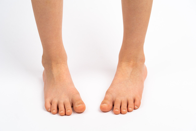 Clubfoot (Pes Equinovarus – İçe Dönük Ayak)