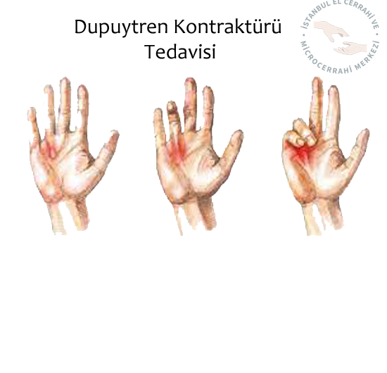  Dupuytren hastalığı