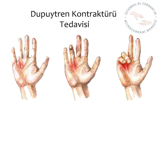  Dupuytren hastalığı