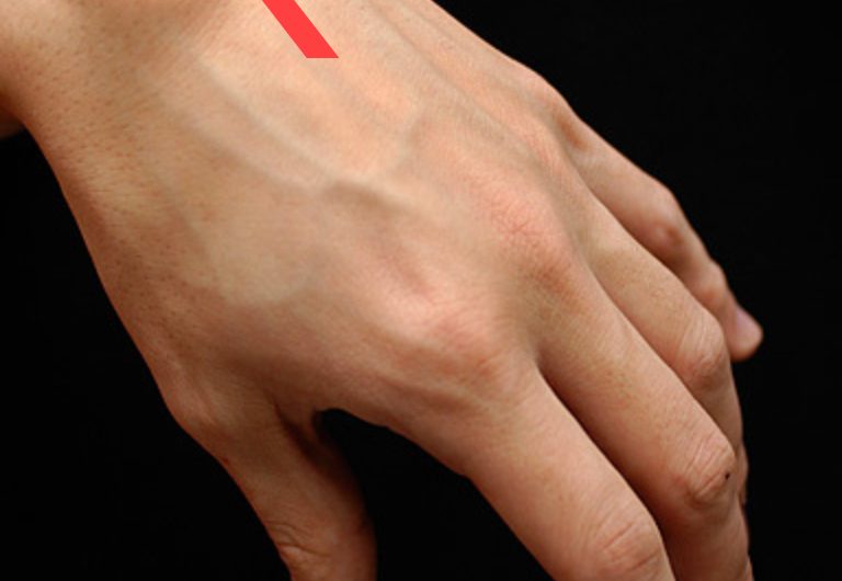  Ganglion kisti