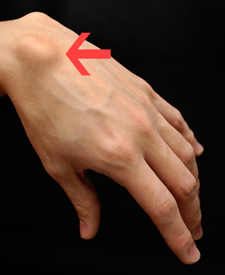  Ganglion kisti