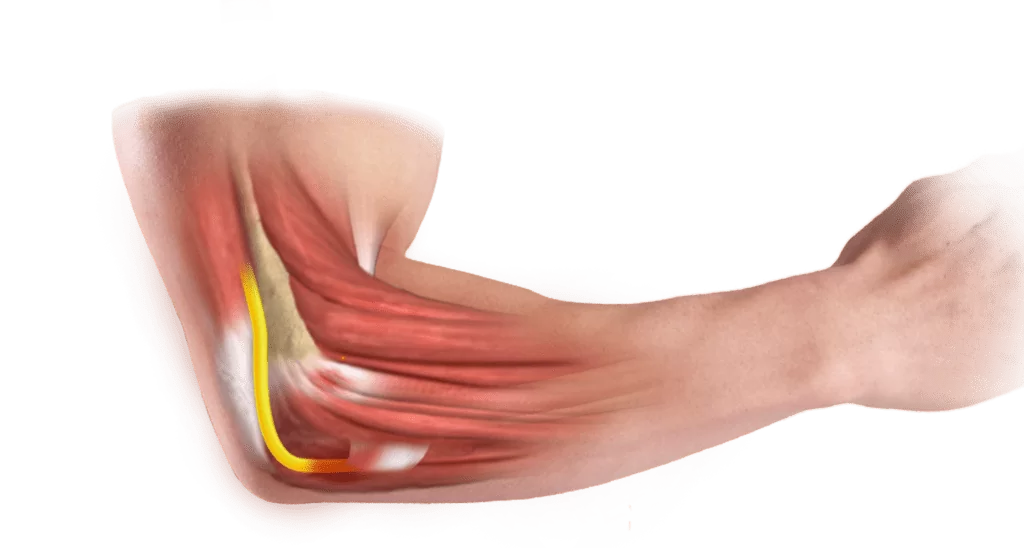  Kübital tünel sendromu