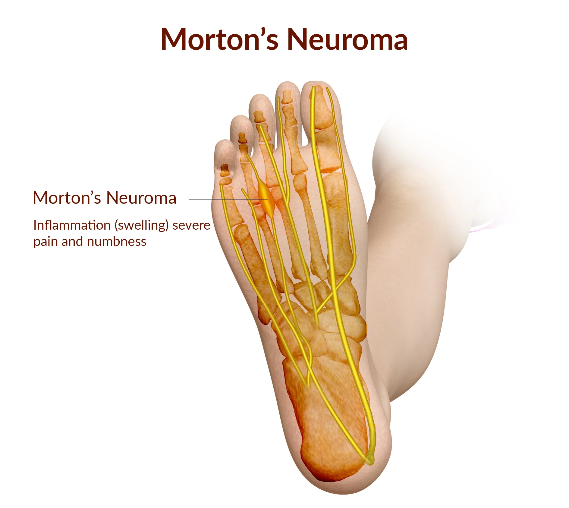  Morton Nöroma