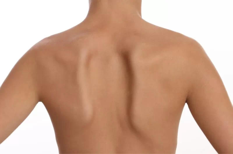 Skapular Diskinezi Nedir? Belirtileri ve Tedavisi