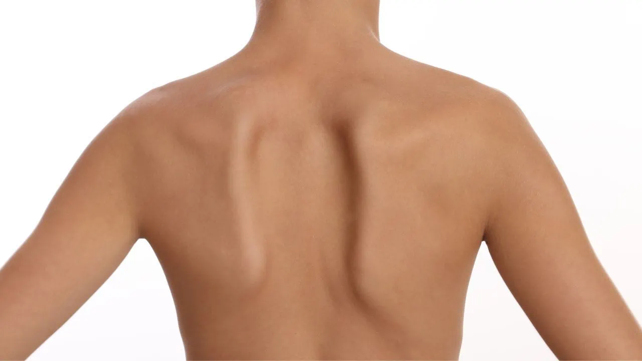 Skapular Diskinezi Nedir? Belirtileri ve Tedavisi