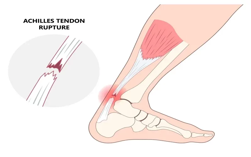  Aşil Tendonu Yaralanması