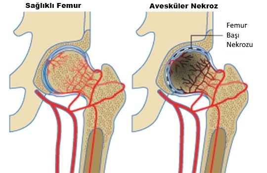  Kalça avasküler nekroz