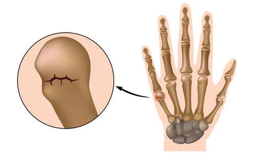  Boksör kırığı nedir? ( 5.metakarp distal uç kırığı)