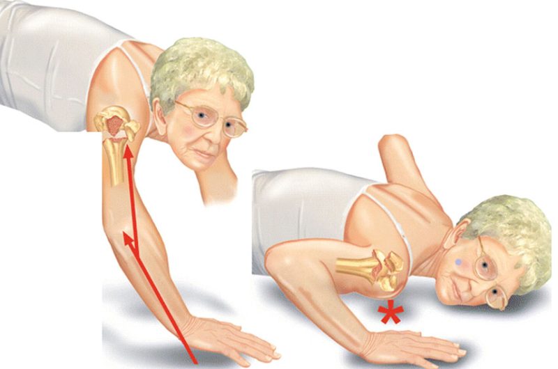 Proksimal Humerus Kırığı Cerrahisi