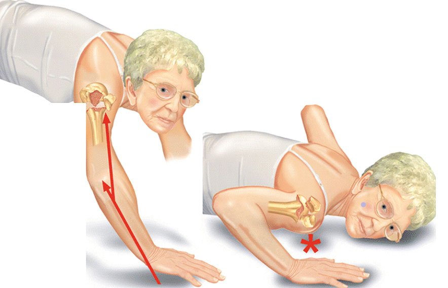 Proksimal Humerus Kırığı Cerrahisi