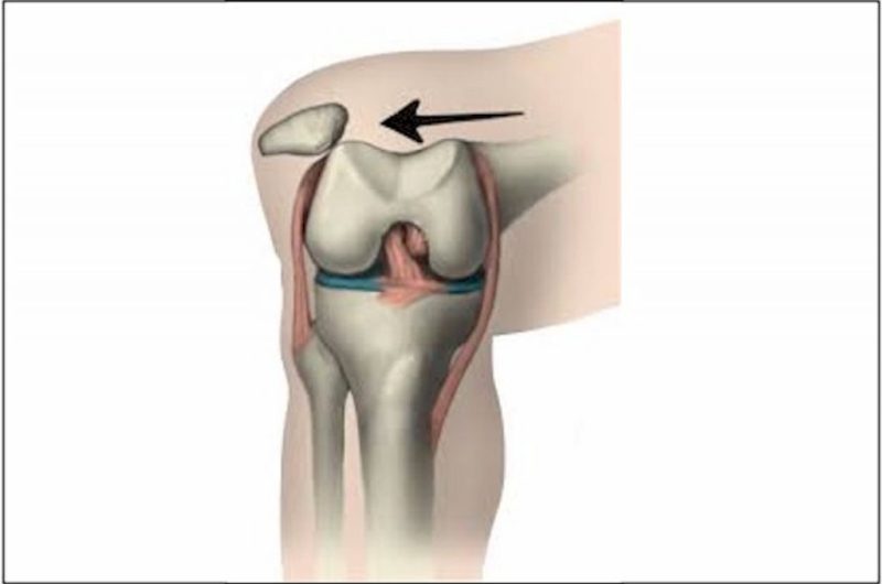 Diz kapağı ( patella) çıkığı
