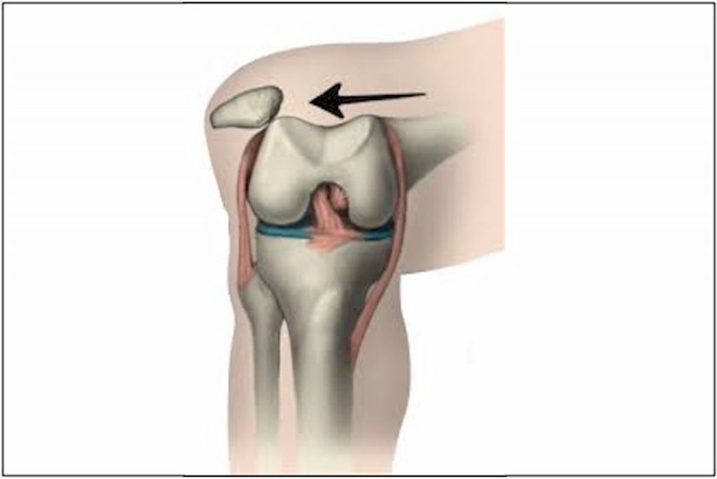 Diz kapağı ( patella) çıkığı