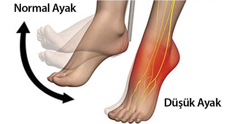 Düşük ayak