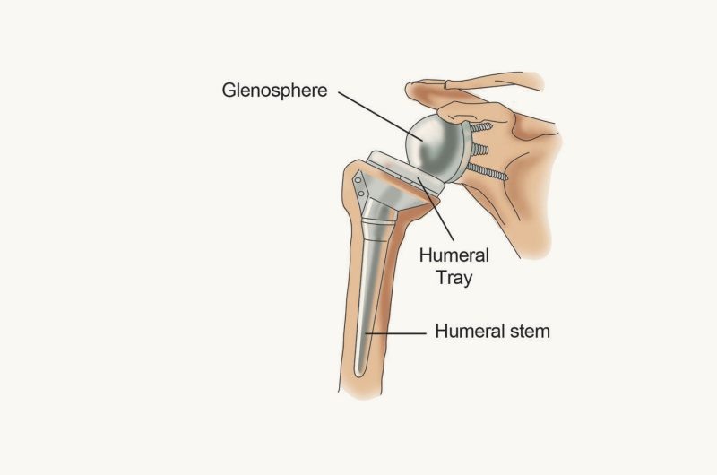 Reverse Shoulder Arthroplasty (Ters Omuz Protezi) Nedir?