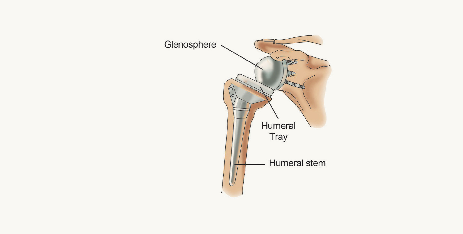 Reverse Shoulder Arthroplasty (Ters Omuz Protezi) Nedir?