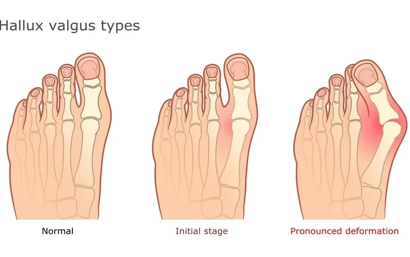 Halluks valgus