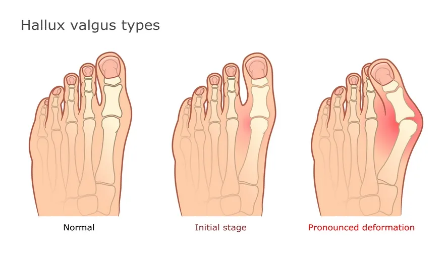 Halluks valgus