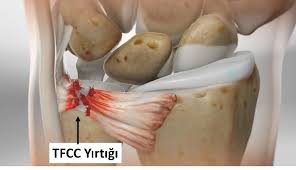  TFCC Yırtığı