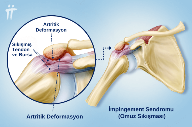  Omuz sıkışma sendromu ( Impingement ) nedir?