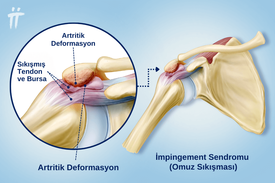  Omuz sıkışma sendromu ( Impingement ) nedir?