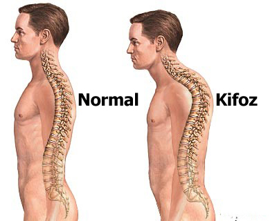 Kifoz