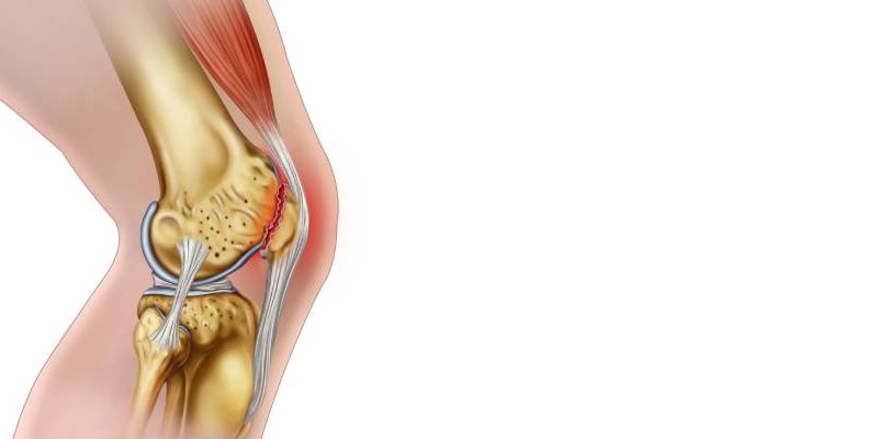  Kondromalazi patella – Eklem denervasyonu