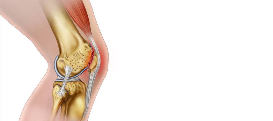  Kondromalazi patella – Eklem denervasyonu