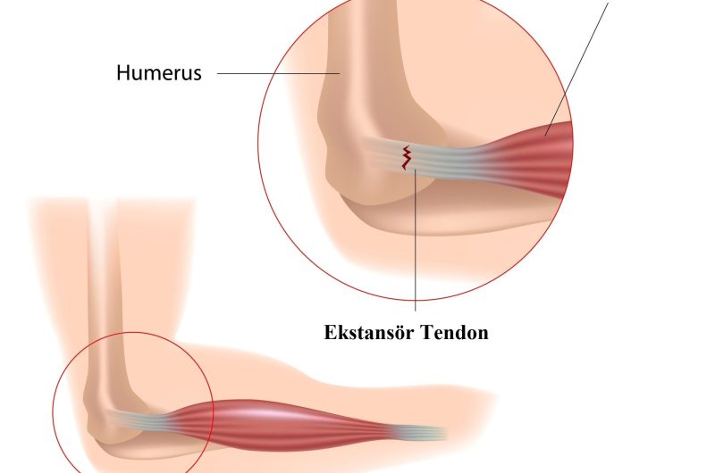  Lateral Epikondilit