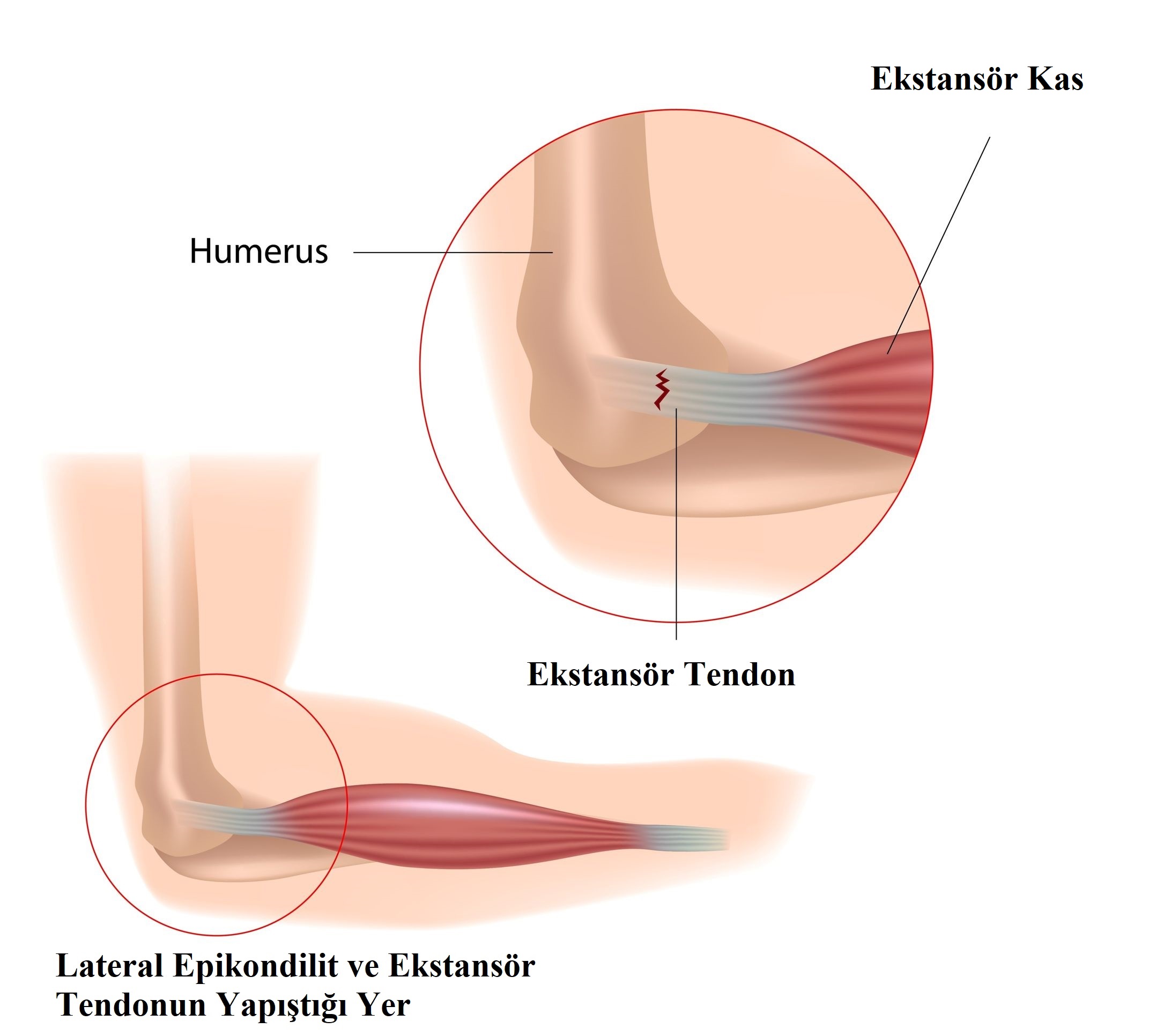  Lateral Epikondilit