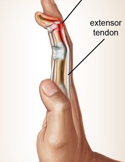  Çekiç parmak – mallet finger nedir?