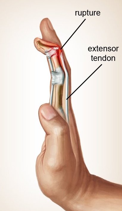  Çekiç parmak – mallet finger nedir?