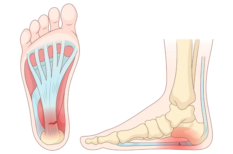 Plantar fasiit ( topuk dikeni)