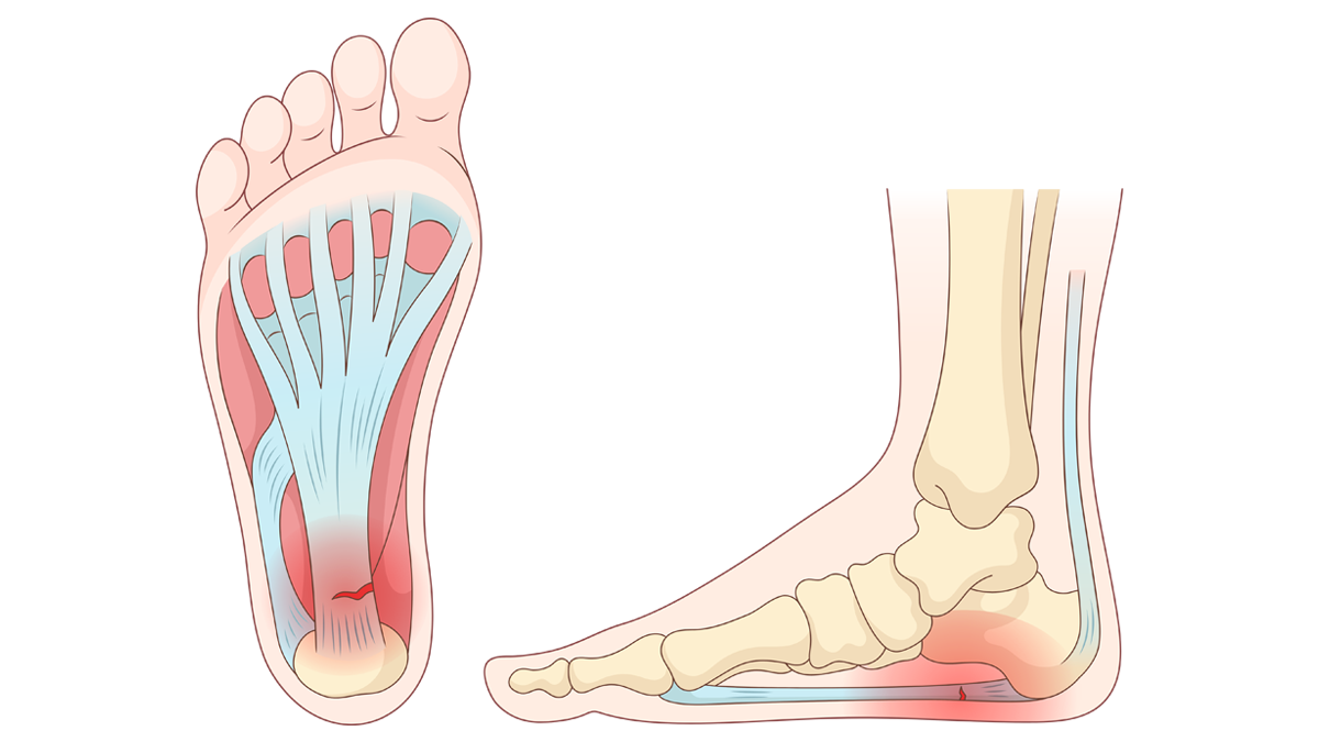 Plantar fasiit ( topuk dikeni)