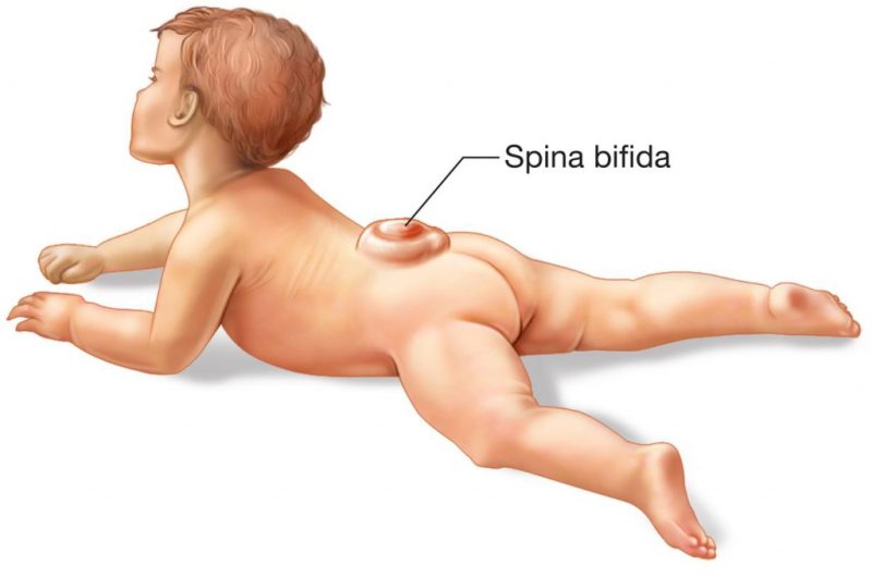 Spina bifida – omurga açıklığı ile doğan çocuklar