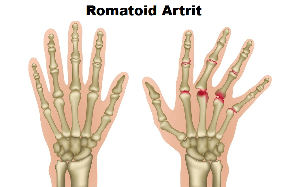  Romatoid Artrit