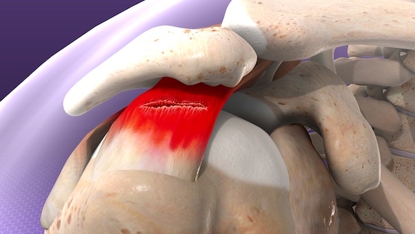 Rotator Cuff (Döndürücü Manşet) Yırtığı Onarımı