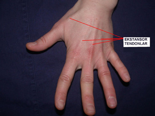  Ekstensör tendon yaralanmaları