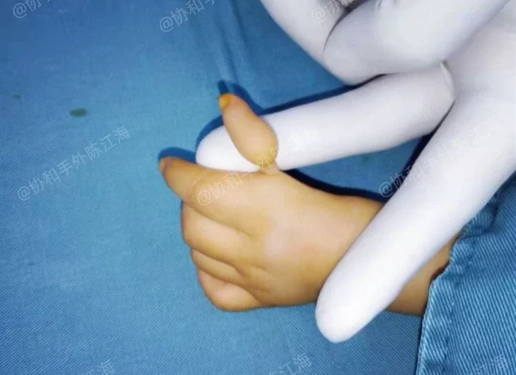  Hipoplastik baş parmak (az gelişmiş veya gelişmemiş başparmak)