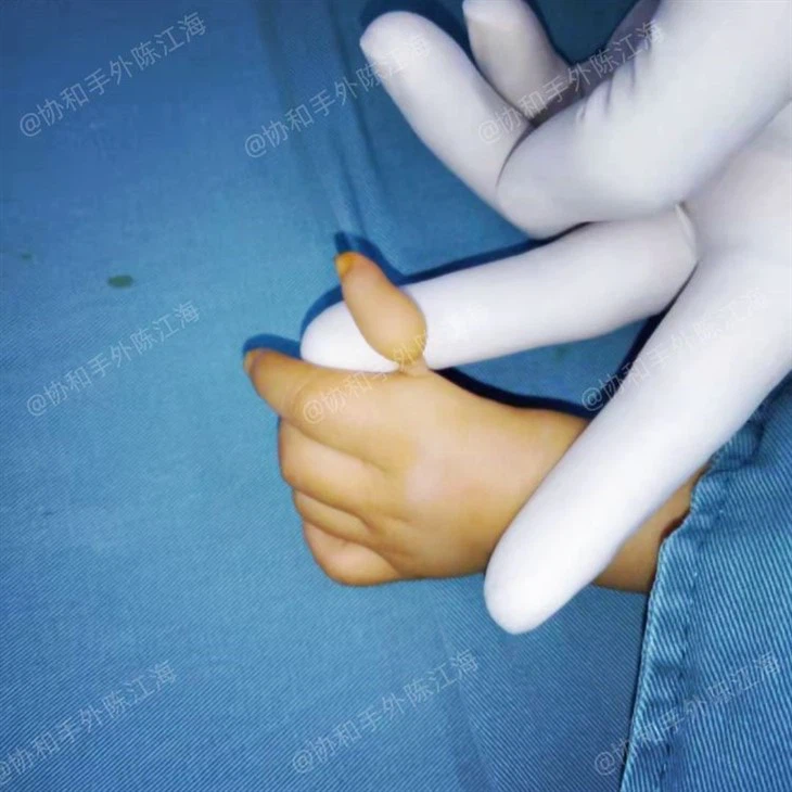  Hipoplastik baş parmak (az gelişmiş veya gelişmemiş başparmak)