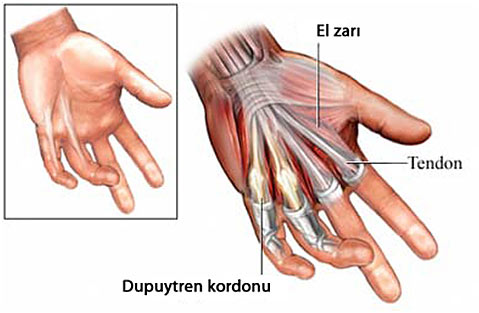 Dupuytren Hastalığı Nedir? Belirtileri ve Tedavi Yöntemleri