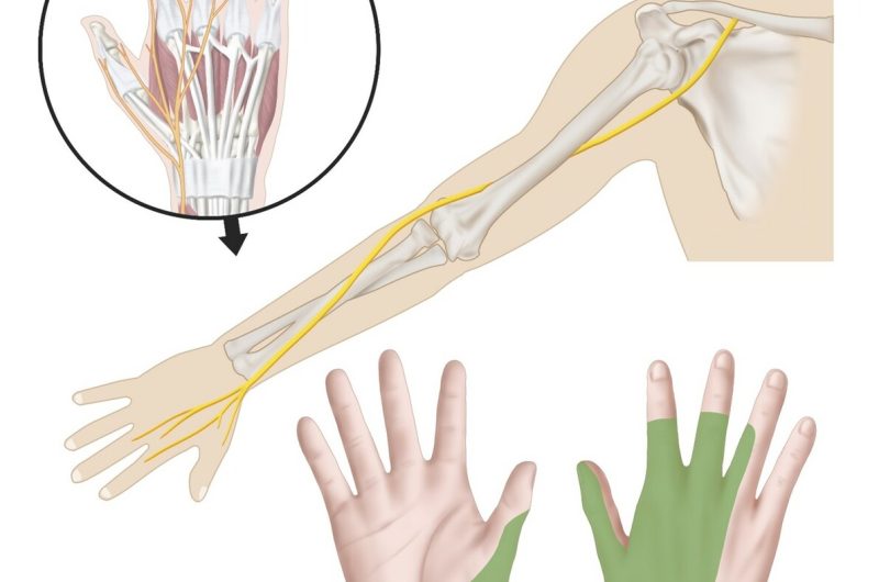 Radial Sinir Felci Sonrası El bileği–Parmak Ekstansiyon Kaybı
