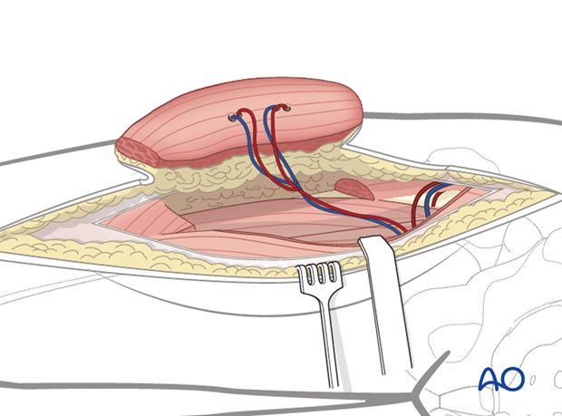 Anterolateral Thigh Flap (ALT) Nedir? Nasıl Uygulanır?