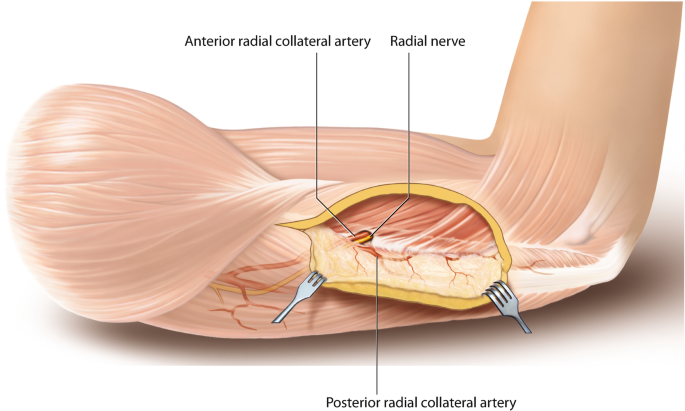 Lateral Arm Flap Nedir? Nasıl Uygulanır?