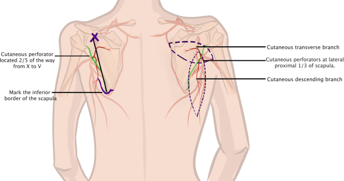 Parascapular ve Scapular Flap Nedir? Nasıl Uygulanır?