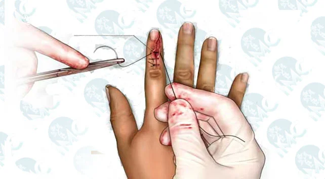 COVID-19 Pandemisi Döneminde Parmak Replantasyon Sonuçları