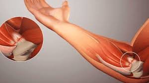 Tendon Grefti Nedir? Nasıl Uygulanır?