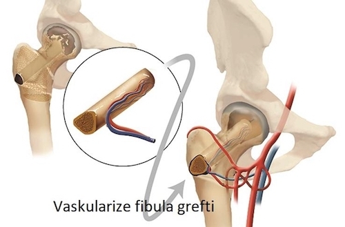 Vaskülarize Kemik Grefti Nedir? Nasıl Uygulanır?